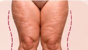 Jambes présentant une augmentation symétrique du volume des cuisses et des mollets