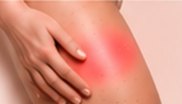 Main appuyant sur une cuisse, zone de douleur signalée en rouge