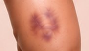 Ecchymose étendue sur une cuisse, apparue sans choc important