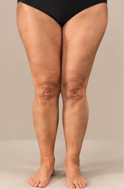 Jambes au stade 1, type II : volume augmenté des cuisses et des mollets, surface de peau encore régulière