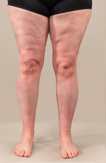 Jambes au stade 2, type II : relief irrégulier marqué au niveau des cuisses et des genoux