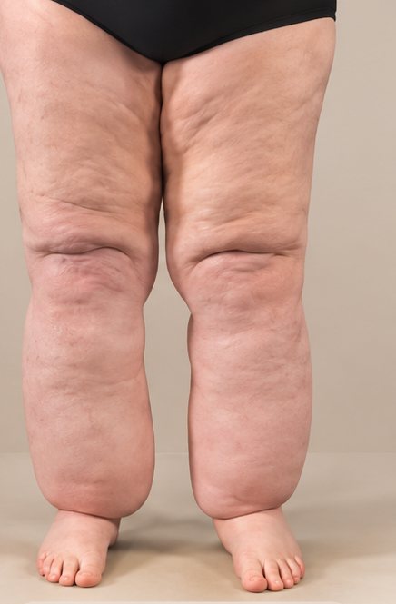 Jambes au stade 3, type III : aspect colonnaire, la jambe perd son galbe entre le genou et la cheville